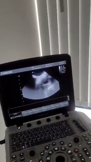 pregnancy confirmed